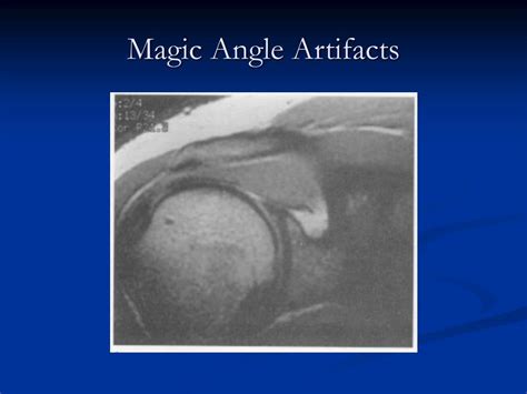 The Magic Angle Artefact in MRI: a Review of the Literature